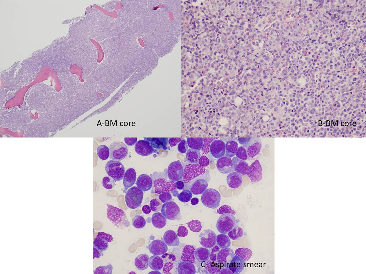 A- The core biopsy is markedly hypercellular. B-Higher power shows there are sheets of blasts. C- Aspirate smear shows blasts with basophilic granular cytoplasm, some clefted nuclei, fine chromatin, and prominent nucleoli.
